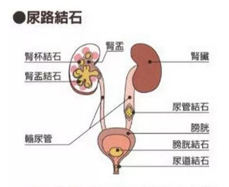 泌尿系统结石等,根据结石所在位置分为肾结石,输尿管结石,膀胱结石和