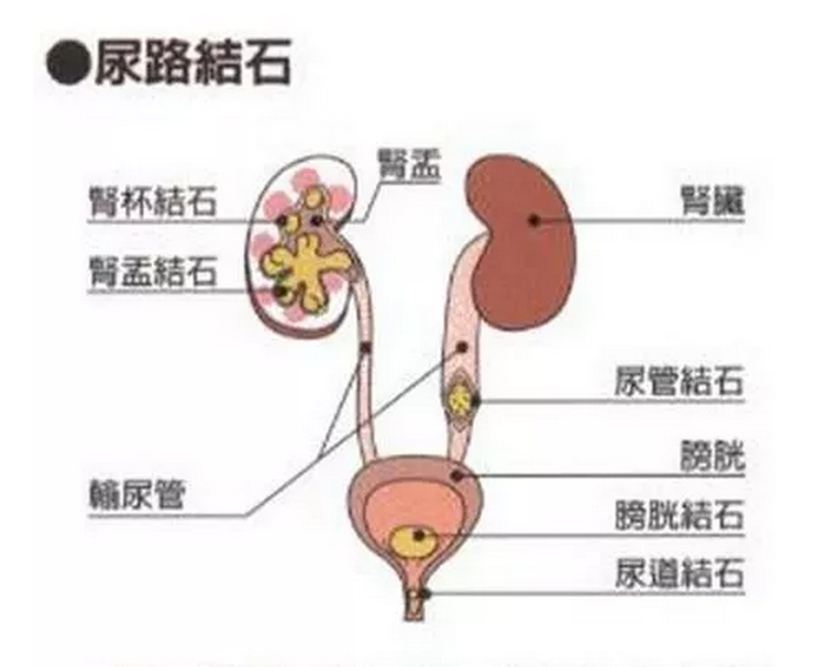 尿路结石又称为尿石症,尿结石,泌尿系统结石等,根据结石所在位置分为