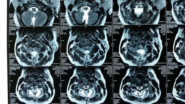 术后影像复查:mri显示枕大孔内至颈2椎管内结节状占位消失.