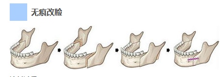 下颌角手术是整形外科中改变人脸型的手段之一,包括磨骨下颌角整形,截