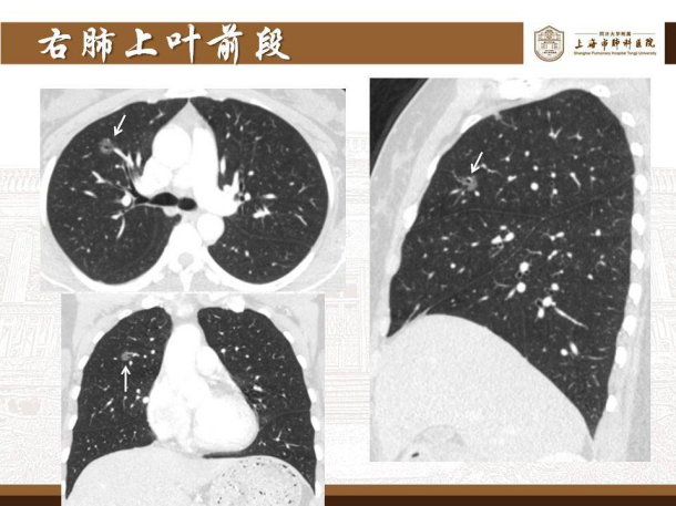 肺磨玻璃结节的微创手术——胸腔镜肺段切除