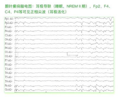 癫痫病各种脑电图波形解答