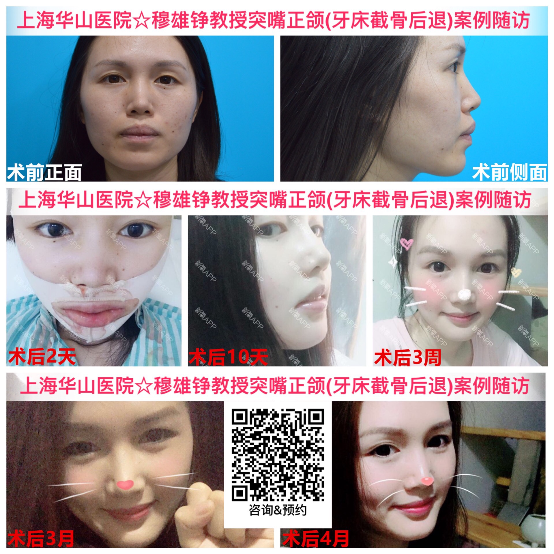 突嘴,大小脸等错颌畸形——以正颌手术优先治疗的新策略