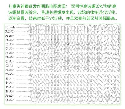 癫痫病各种脑电图波形解答