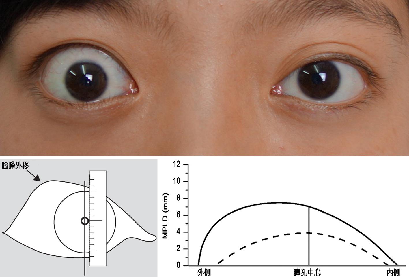 瞳孔中心至上睑缘距离(mpld)的正常范围是3.5～5.5 mm.