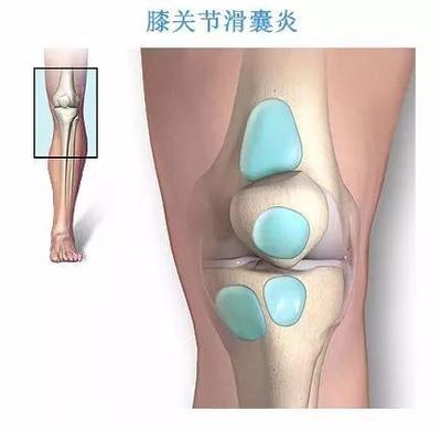 其中任何一处的感染都可能会导致膝盖骨表面或下方内侧的滑囊炎