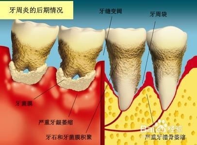 牙周炎