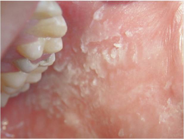 介绍口腔黏膜白色病变-白色海绵状斑痣