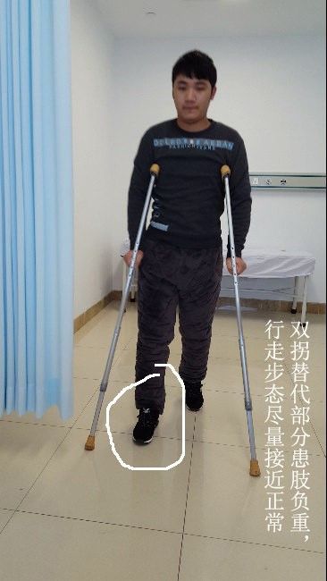 下肢骨折患者扶拐与步态矫正