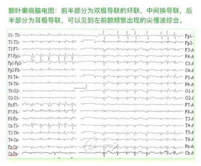 癫痫病各种脑电图波形解答