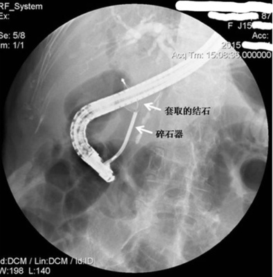 ercp治疗老年患者胆总管巨大结石