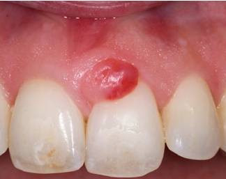 为有蒂或无蒂包块,质地坚实,颜色与附近牙龈相同,如有炎症或血管丰富