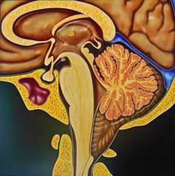 小脑扁桃体下疝畸形的分型介绍——Ⅱ型