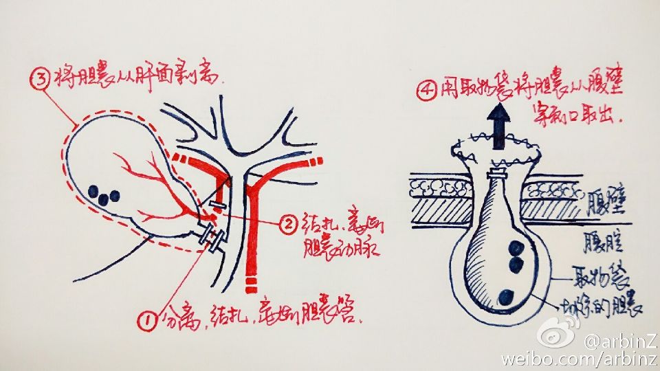 画说胆结石
