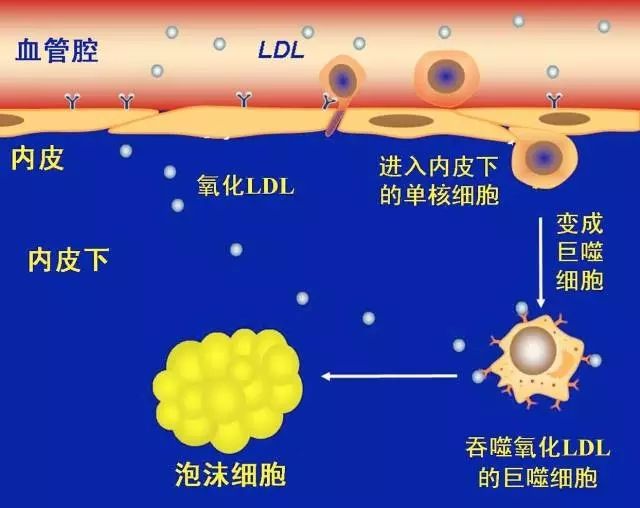 (胆固醇酯颜色)的泡沫细胞(图2).