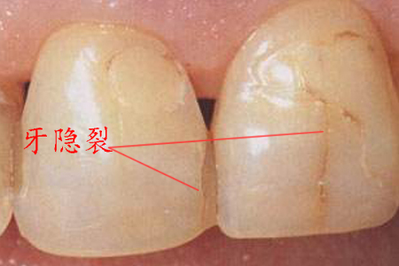 就有可能导致牙体出现裂痕,或崩裂,医学上称为牙隐裂