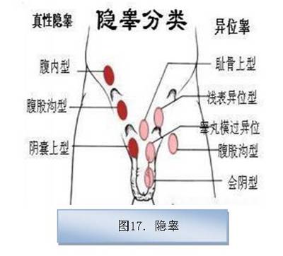 但松手后睾丸又回到原来的位置;游走睾丸是指睾丸在阴囊内或阴囊外