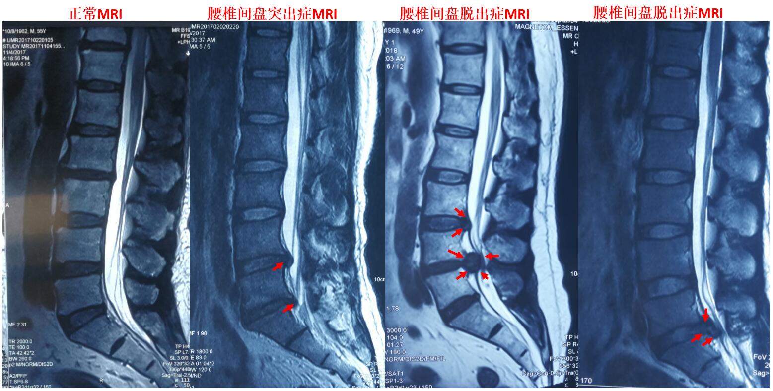 核磁共振检查(mri)是诊断腰椎间盘突出症最为合适的无辐射,无创伤