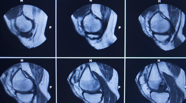 膝骨性关节炎诊断有方法,核磁共振用处不大