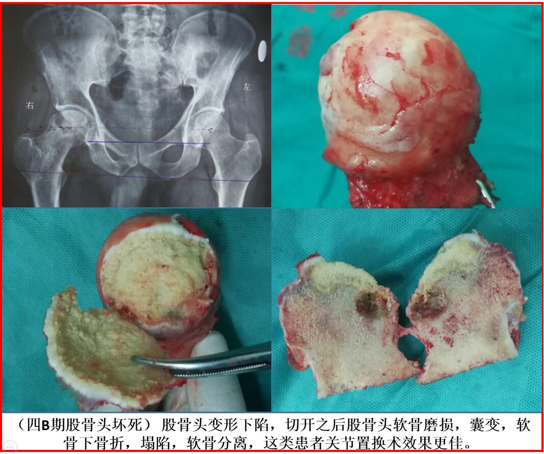 股骨头坏死的外形分期