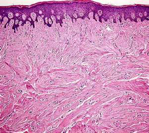 正常皮肤结构切片            瘢痕组织切片 皮下大量胶原形成