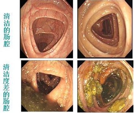 那么如果您准备做肠镜检查,为了检查的质量,避免漏诊一些息肉甚至早