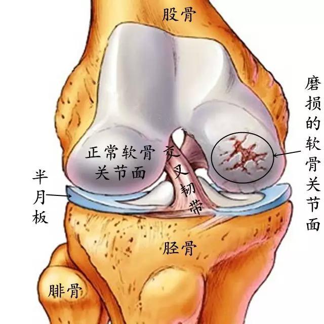 全膝关节置换手术:哪些人适合做,哪些人不适合?