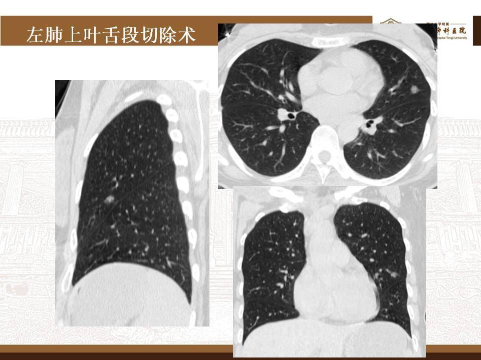 肺磨玻璃结节的微创手术——胸腔镜肺段切除