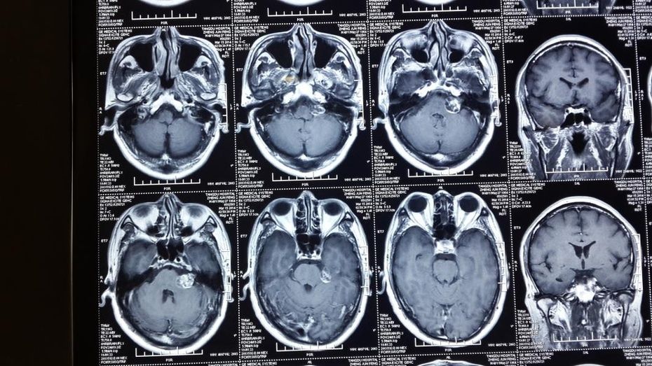 例3术前增强mri(轴位:左桥小脑角听神经瘤