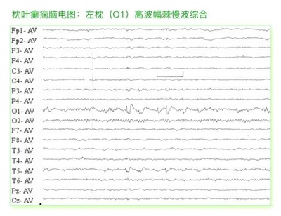 小儿癫痫-这个脑电图是否确诊为羊癫疯