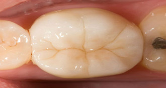 牙套保护 裂缝发生在牙齿垂直方向