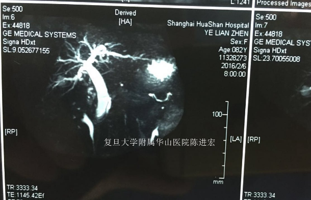 1mrcp提示胆总管下端梗阻