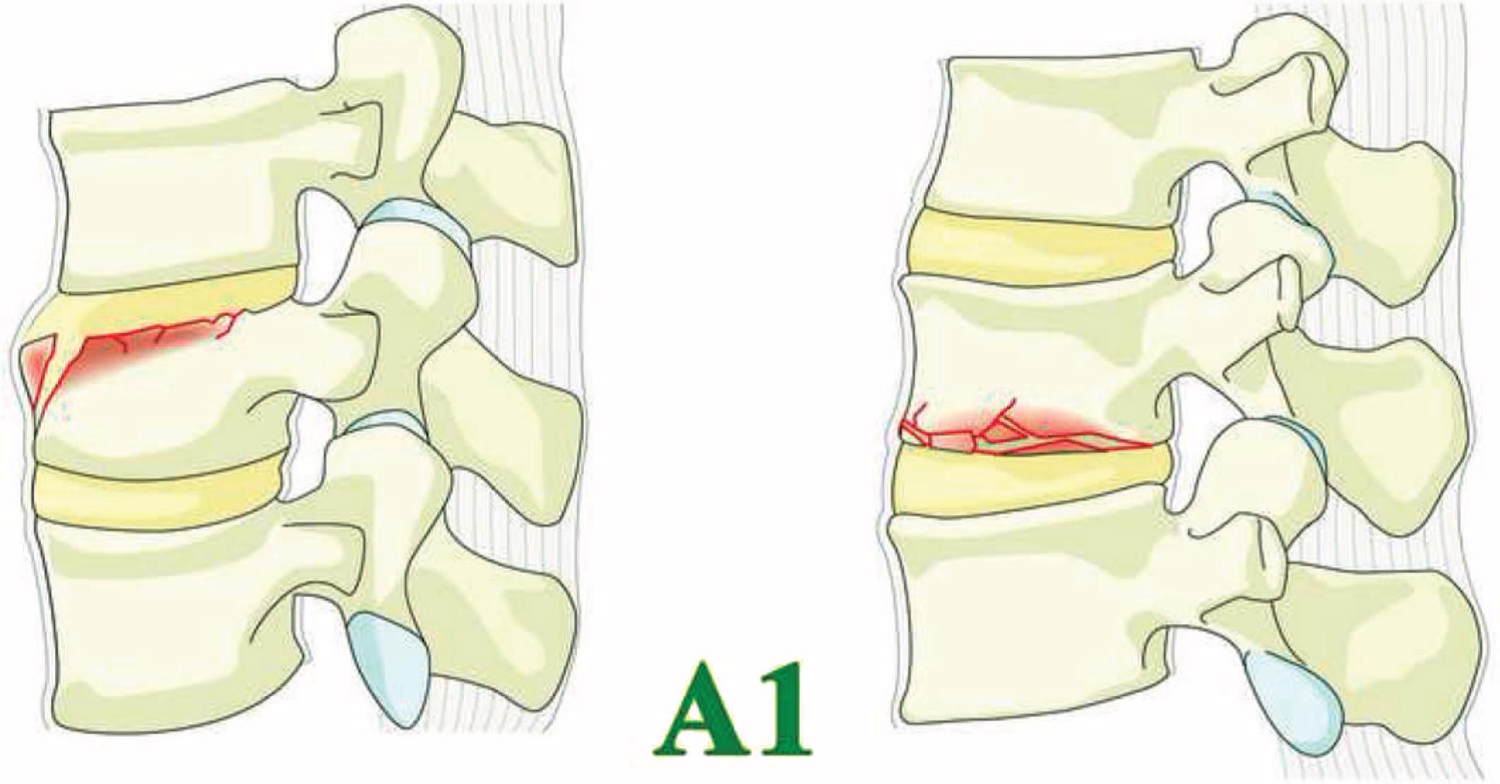 图-4.a1亚型-边缘压缩:单一终板骨折未累及椎体后壁.椎管完好无损.