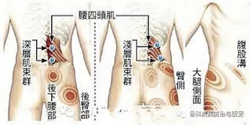 有一种伤不起的痛,叫肌筋膜炎