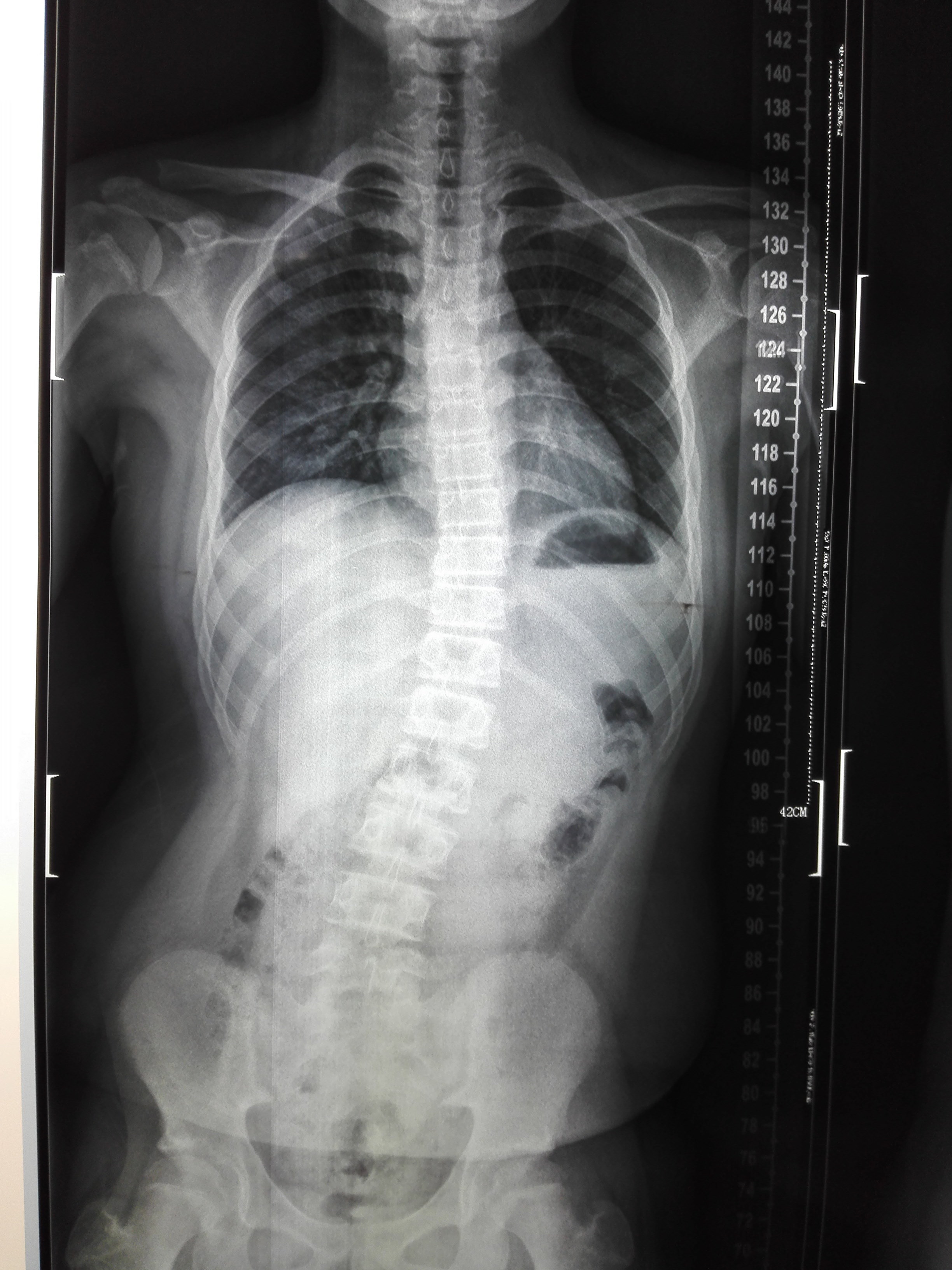 十三岁的腰间盘突出脊柱弯曲,正骨治疗后已经恢复