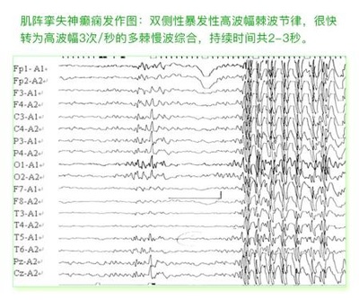 癫痫发作症状后到医院进行检查时,一般都会接受长程视频脑电图监测