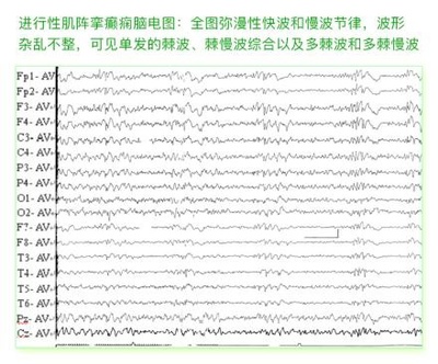 癫痫病各种脑电图波形解答