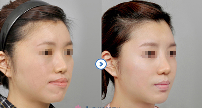 颌面整形能够达到精致改脸型的目的