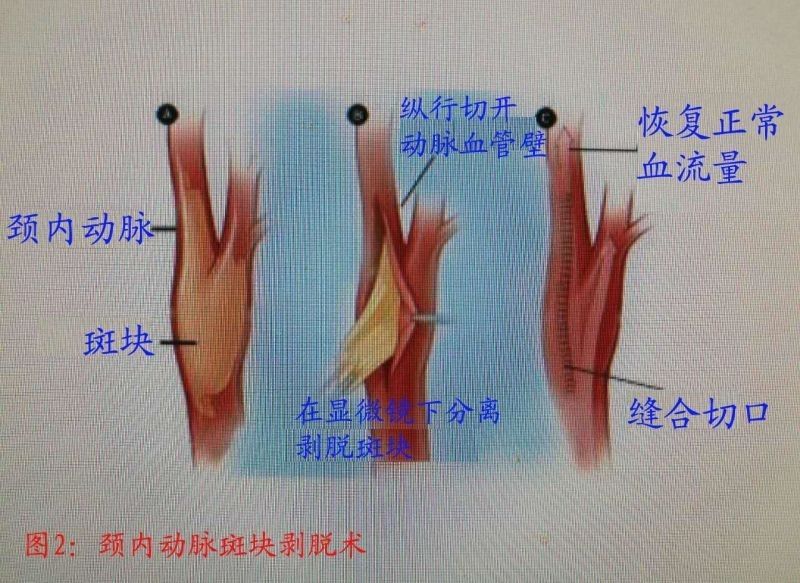 颈部血管内有了斑块,对身体有什么影响吗?