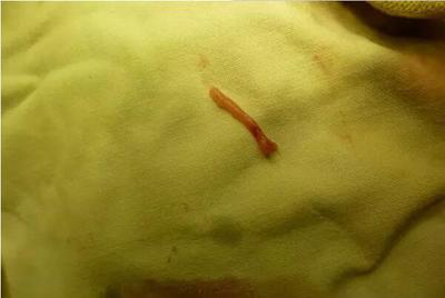 术后3个月,从引流管口取出的肉芽肿条,长4厘米,直径3毫米.