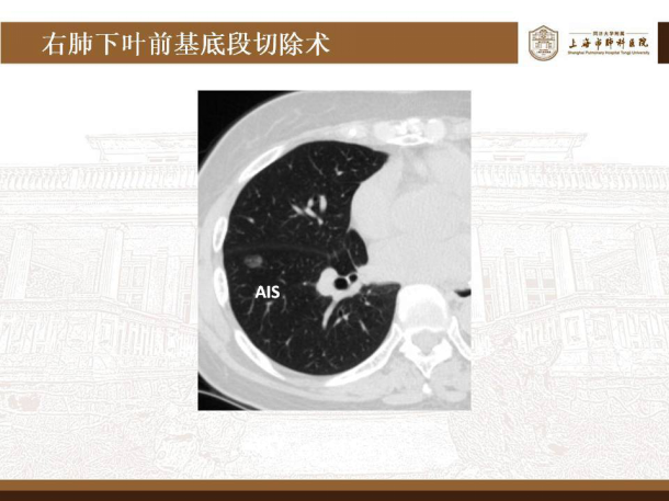 肺磨玻璃结节的微创手术——胸腔镜肺段切除