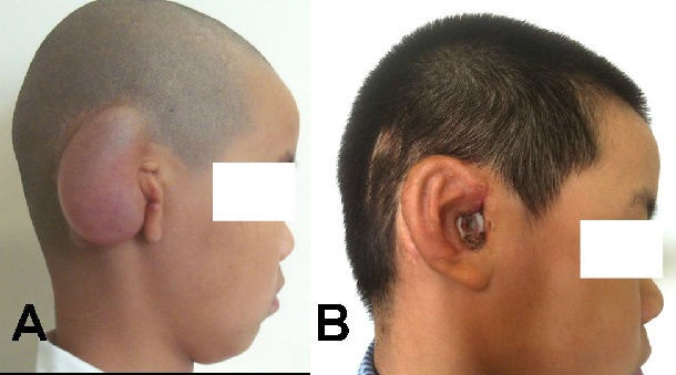 耳廓再造,耳道再造及其综合效果(图片)