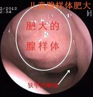 儿童腺样体肥大是怎么回事?