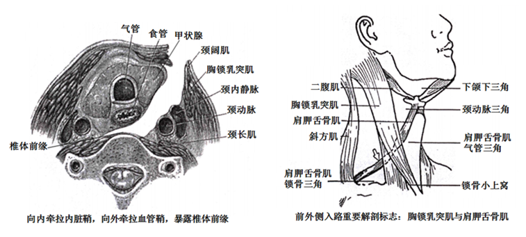 安放引流管1根,彻底止血,缝合肩胛舌骨肌及颈深筋膜,皮肤做皮内缝合.