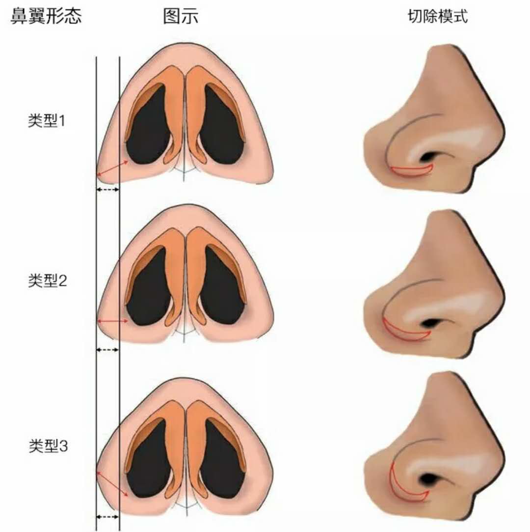 鼻翼缩小内切,外切还是纵切