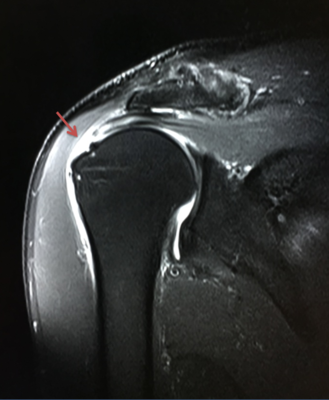 肩关节mri一个层面显示肩袖肌腱(冈上肌腱)撕裂