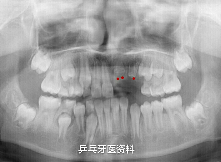 患儿 9岁 全景x线片 右上牙发育正常 左上3颗停止发育 注:红点标记处