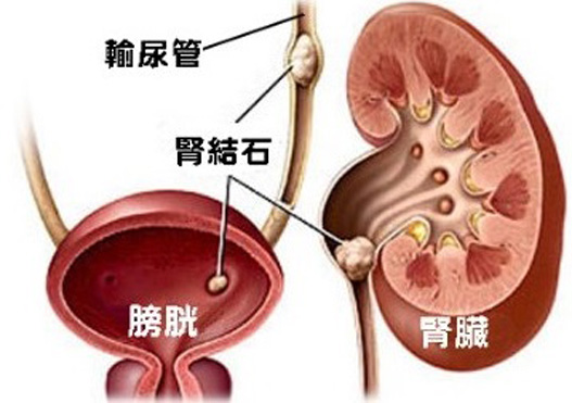 根据结石所在部位的不同,尿路结石分为肾结石,输尿管结石,膀胱结石和