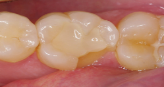 隐裂牙修补后 2,下列重度隐裂,牙齿劈裂,需要牙套保护.