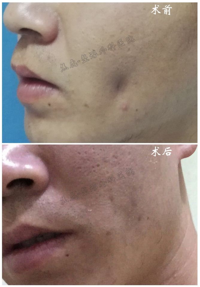 患者男性,1年前因面颊部感染流脓后遗留明显凹陷性疤痕,微笑时凹陷
